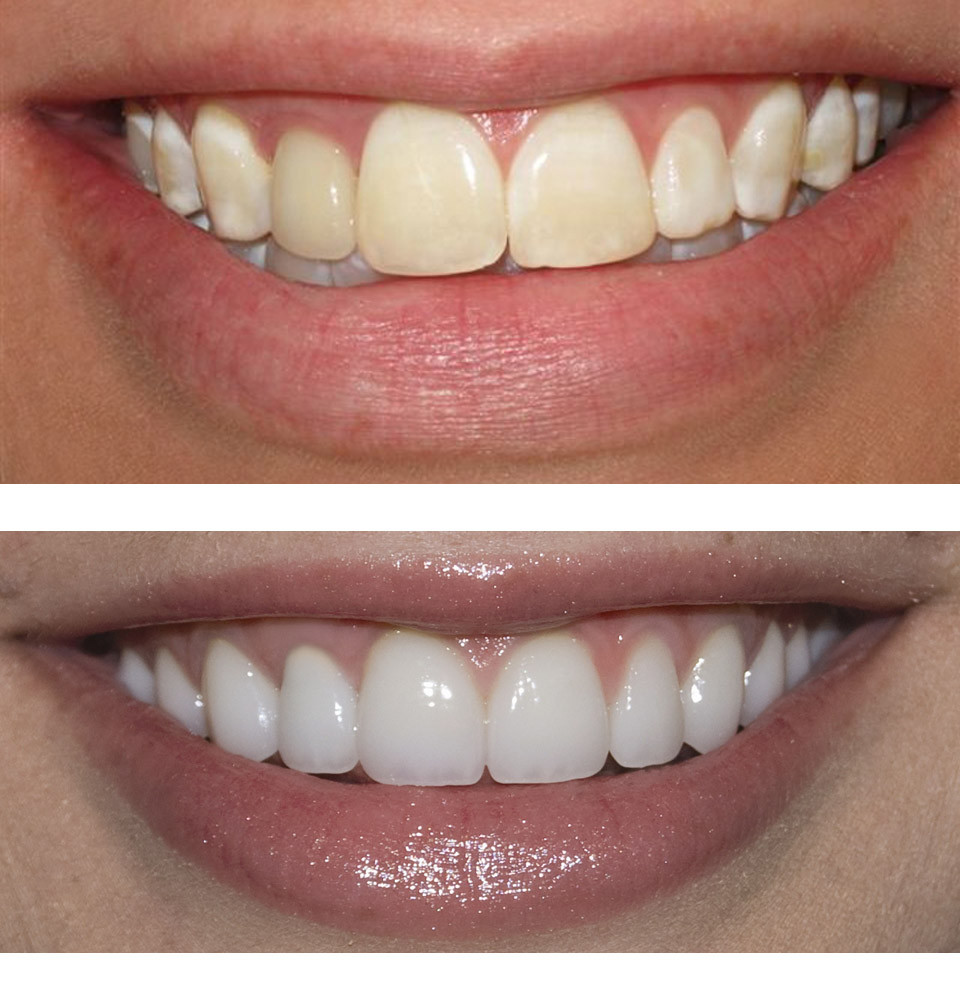 Hình ảnh trước và sau tẩy trắng răng 2