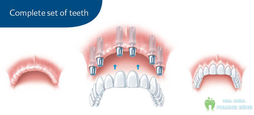 Cắm răng Implant được coi là một trong những giải pháp tối ưu nhất