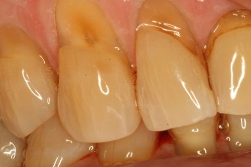 Tại sao mòn chân răng (cổ răng)? phòng ngừa và điều trị như thế nào?