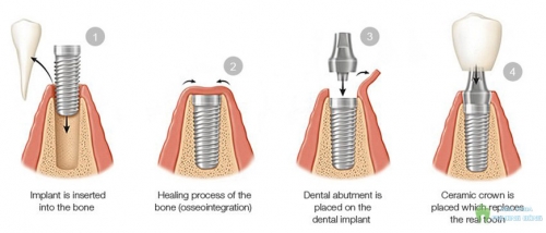 Cấy ghép răng implant ở đâu tốt ?
