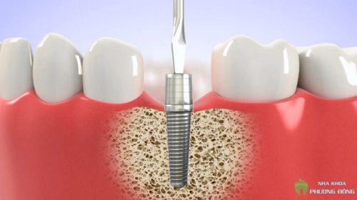 Răng sứ implant giá bao nhiêu ?