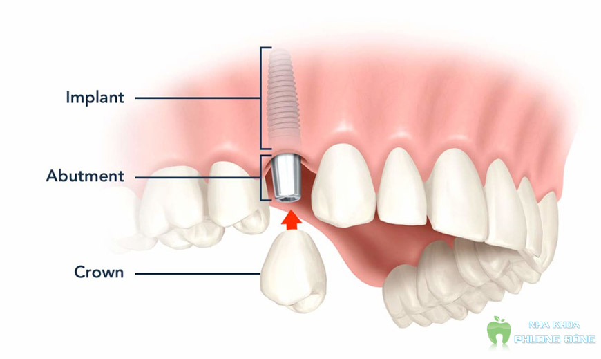 Implant được chỉ định cho hầu hết các trường hợp mất răng