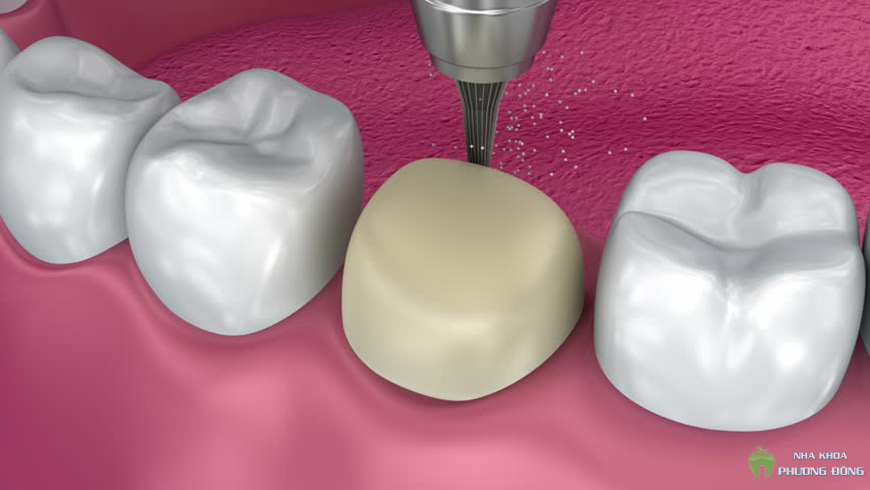 Răng sứ titan được các nha sĩ khuyên dùng