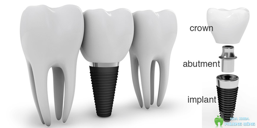 Implant được cấy vào xương hàm thay thế cho răng đã mất
