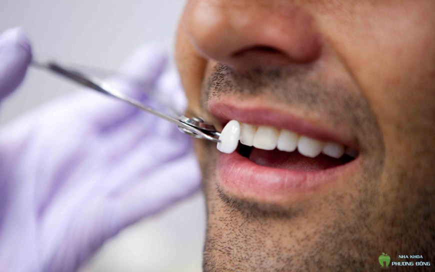 Răng sứ Mỹ được các trung tâm nha khoa ưu ái sử dụng