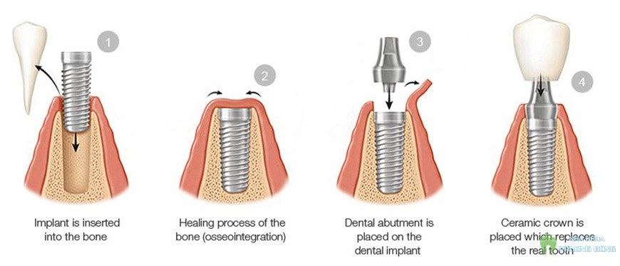 Phương pháp cấy ghép implant