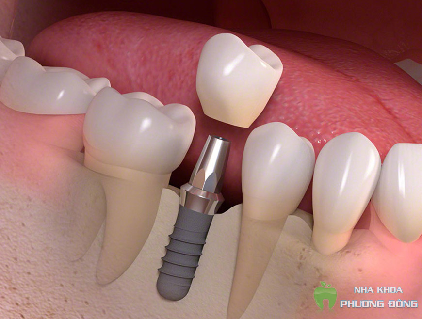 Implant không làm tổn hại đến những răng tốt kế cận