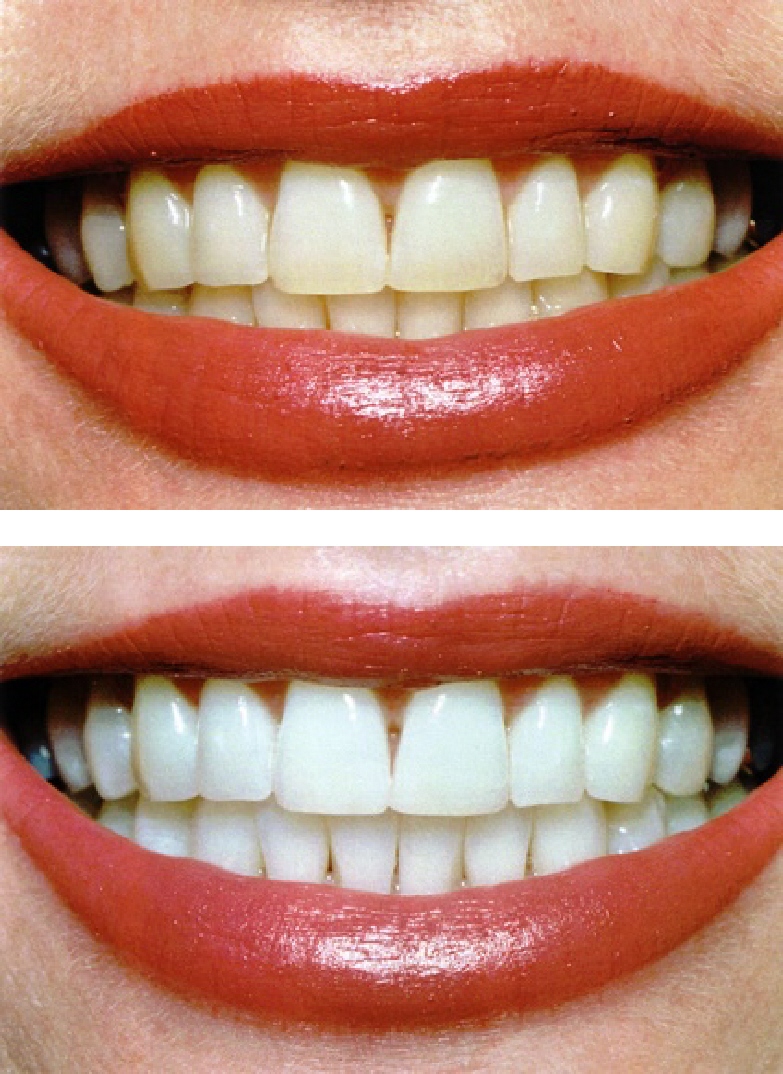 Hình ảnh trước và sau tẩy trắng răng 1