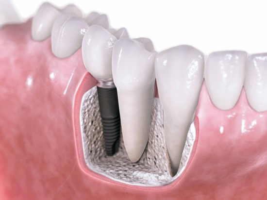 Implant Nha khoa - Lựa chọn tốt nhất cho các trường hợp mất răng